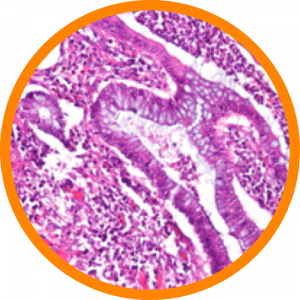 Microscopic enlargement of IBD