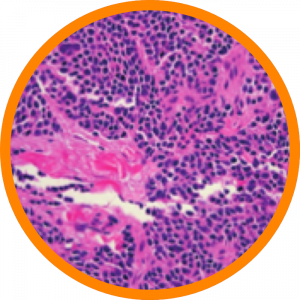 Microscopic enlargement of Merkel cell carcinoma