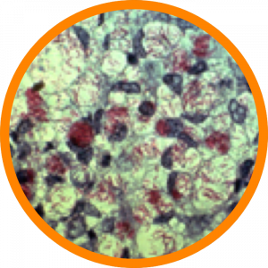 Microscopic enlargement of Leprosy