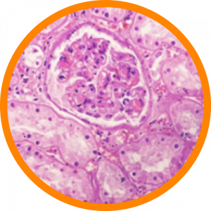 Microscopic enlargement of acute kidney injury