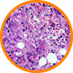 Microscopic enlargement of Leishmaniasis
